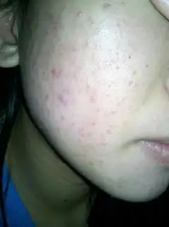 痘痘敏感肌求救.本人今年22.女