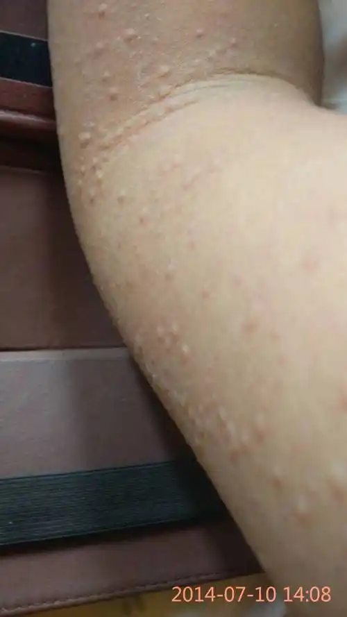 有图.很多.痒.应该是过敏有过敏史.怎么办.用什么药