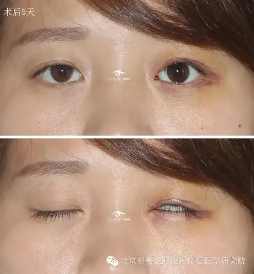 2015年9月23日b顾客左侧上睑下垂矫正术后3个半月恢复过程及效果展示