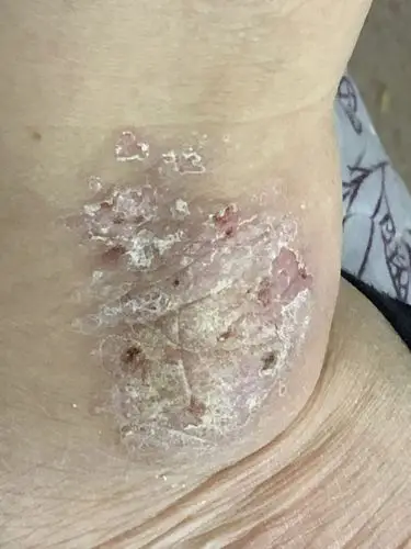 脚祼出现皮肤瘙痒症,哪个解决,谢谢!