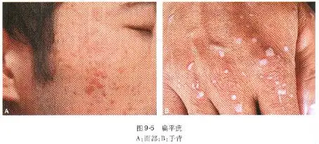 生殖器疣(genital wart) 又称尖锐湿疣(condyloma acuminatum)