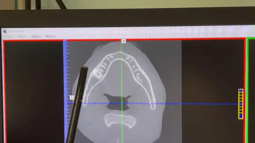 下颌第二磨牙的阻生