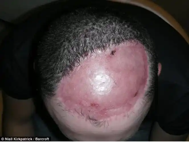 为了去掉一个「痣」,医生给她头皮灌入 4 个大水球_扩张_蒋敏_手术