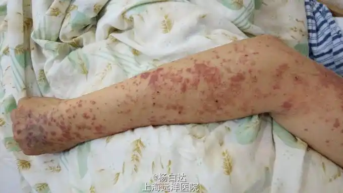 重症多形红斑型药疹