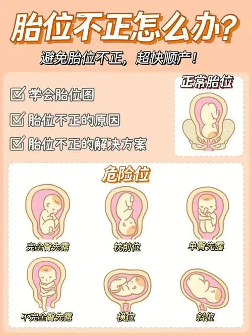 胎位不正应该怎么纠正教你学会看胎位图