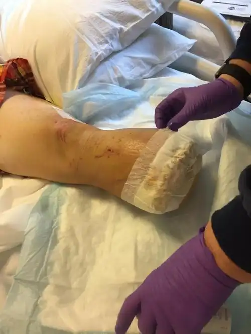 截肢后他把自己大腿肉分朋友吃了这个男人的经历看吐了无数网友