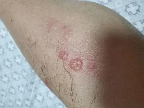 突然发现小腿上长了两颗脓包,摸着是软的,没有破皮和小孔.