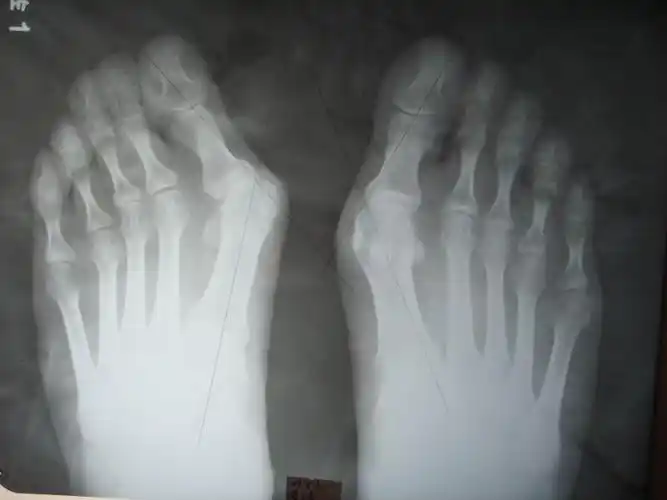 大脚骨矫正到哪里-大脚骨矫正手术