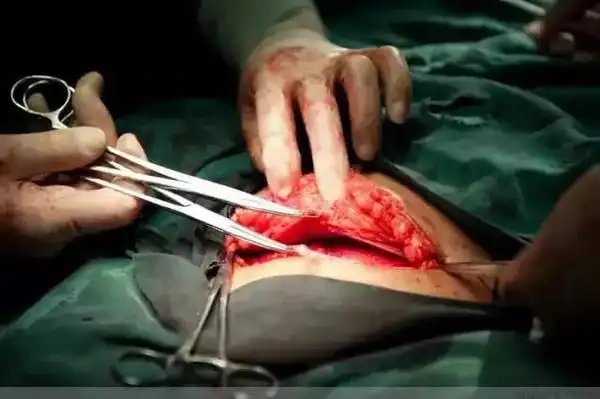 实录:100%还原剖腹产真实全过程,妈妈真的太伟大!_手术