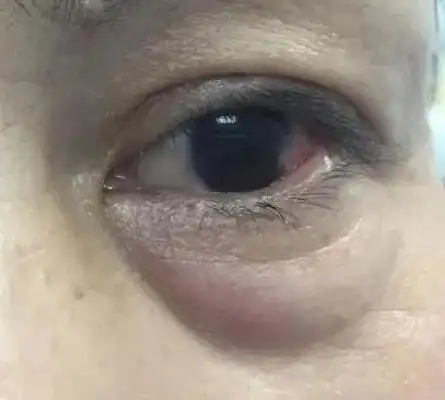 针对脂肪型的眼袋仙女,除了 昂贵,疼到受罪的医美切除.