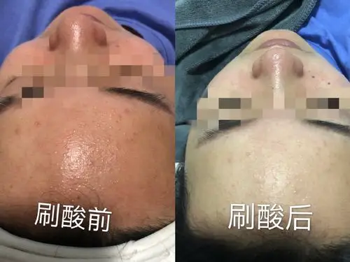 今天跟大家分享刷果酸的好处!