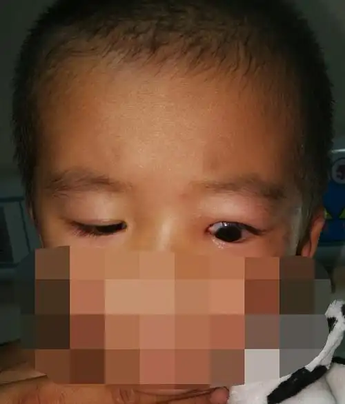 改良联合筋膜鞘悬吊(cfs)矫正低龄儿童上睑下垂效果对比 - 好大夫在线