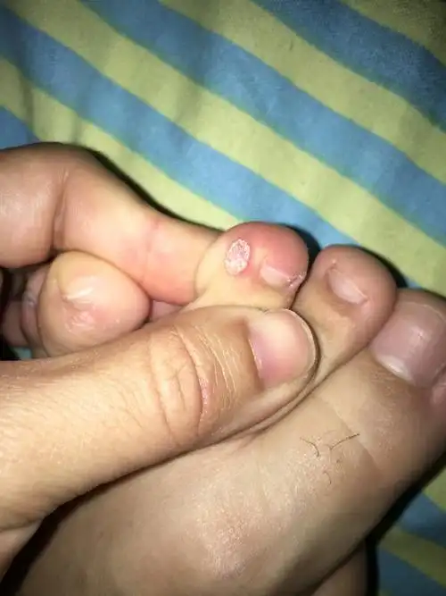 请问我脚上长了一个莫名其妙的肉刺,想问问知情人士能否告知我这是什