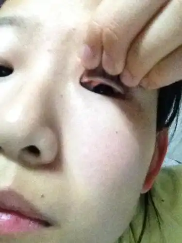 两边眼皮里都有这样的疙瘩,很多年了.