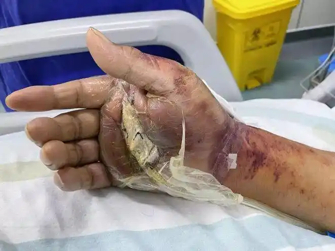 手被鱼刺扎了一下,深圳男子差点丧命|创伤|毒血症|弧菌_网易订阅