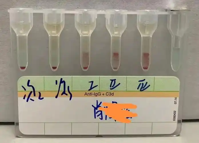 疑难abo血型鉴定之冷凝集处理策略附案例分享