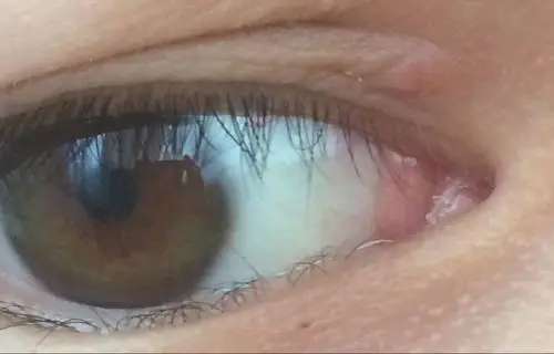 眼角起了个小疙瘩不痛不痒这几天好像有点变大刚才抠红了