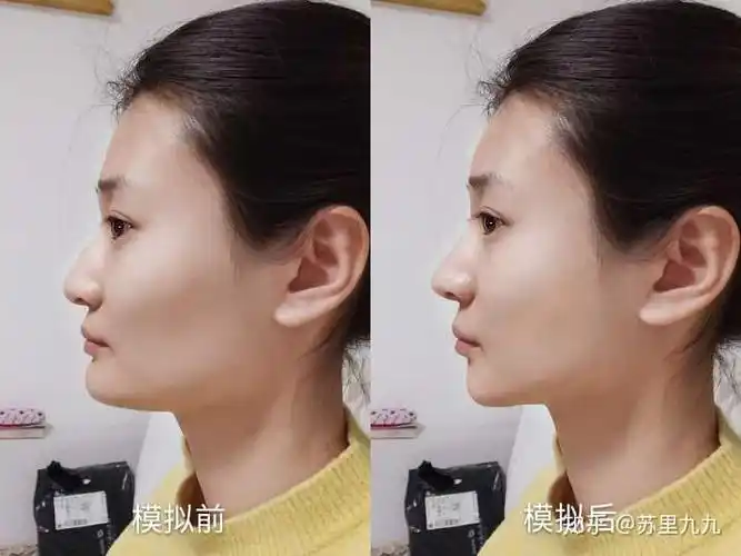 下巴前突 下巴前突严重就会显得整个下面部都前突,轮廓不够好看; 3.