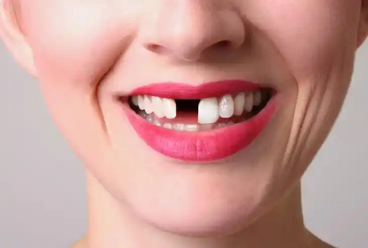 【牙齿缺失修补】_形美网