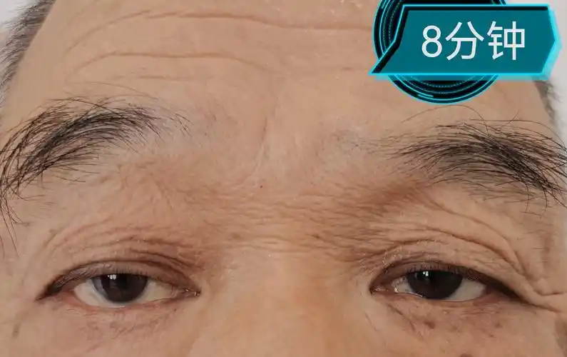 一老年患者眼皮下垂,检查发现竟然是重症肌无力.