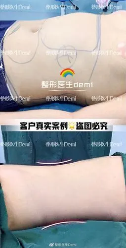 腰腹环吸多久可以恢复