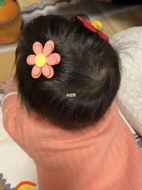 4个月宝宝头型,太阳穴还有凹陷,有犄角是舟状头么?#宝宝头型  #舟状头