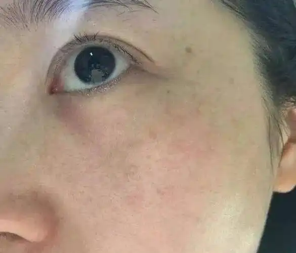 妇科中医:女人气血不足,面部暗沉长黄褐斑,3物调理逼退黑色素_皮肤