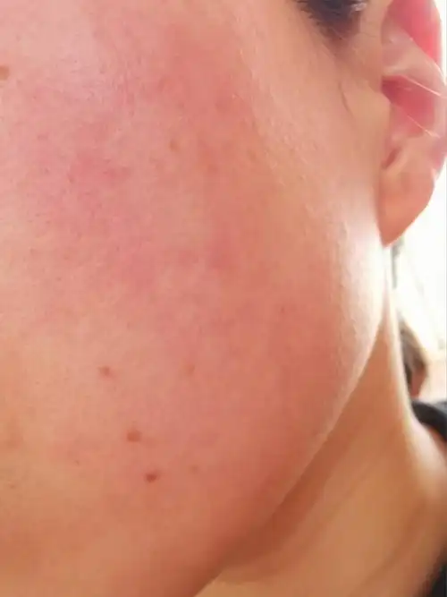 春季脸上过敏发红发痒怎么办