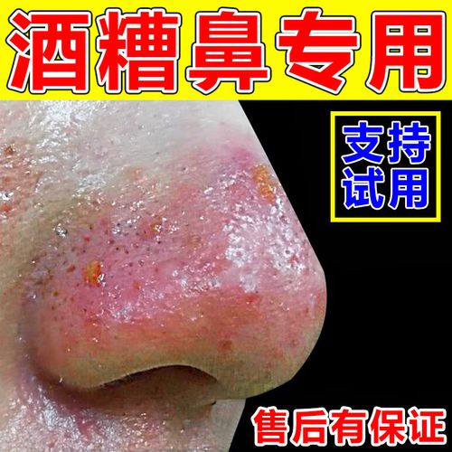 草莓鼻红鼻子红血丝去黑头粉刺螨虫寻常痤疮脂溢性皮炎收缩毛孔粗大膏
