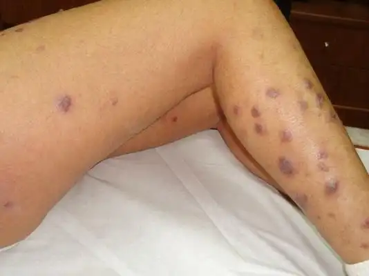 艾滋初期皮疹图片40