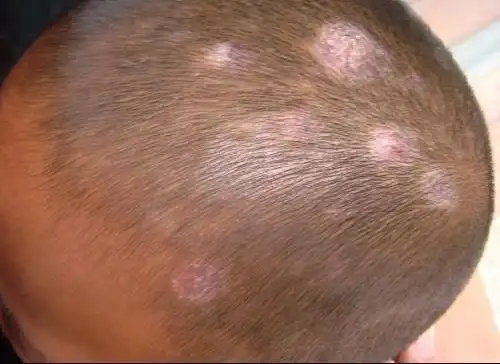 头部脂溢性皮炎词条图册_百度百科