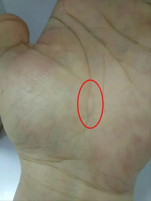 此处有岛纹,或断裂,表明肾功能衰退.