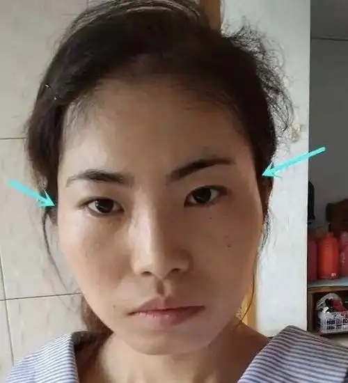 脸两侧颧骨太宽图片