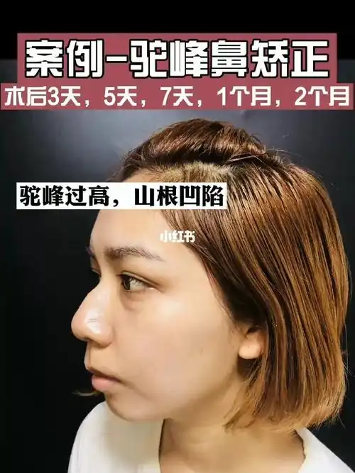 案例实拍驼峰鼻矫正