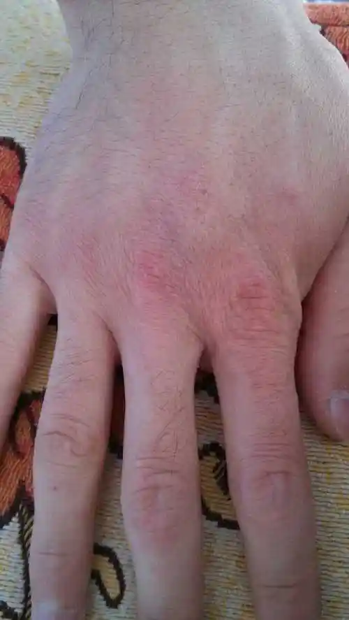 [小夫妻]谁有治疗干湿疹的方法?