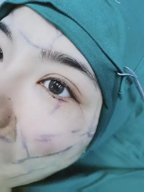 下眼下至术后即刻