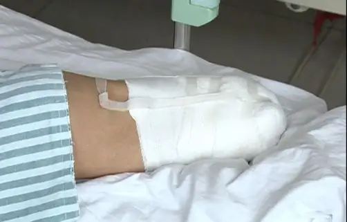 脚底的茧不能想剪就剪,女子因此不幸遭截肢