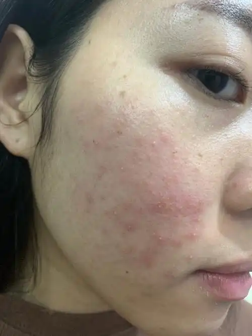 这个皮炎是要从2016年开始因为脸部长了一颗很上火发炎的痘