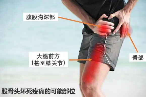 虽然髋关节疼痛是股骨头坏死的典型症状,但绝大多数的"髋关节疼痛"和