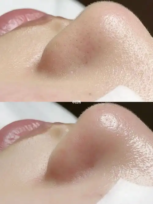 平衡与营养打造无暇肌肤的前提都要在完美清洁的前提下进行#毛孔清洁