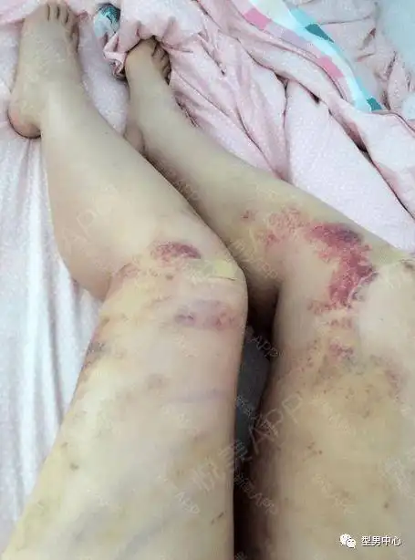 女网红抽脂去世生前照片惨不忍睹变美还是要命