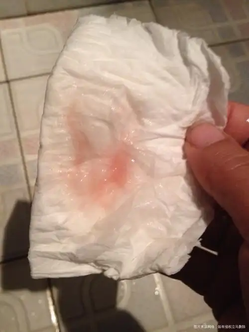 以扫除除非疾病,如阴道宫颈子宫内膜及卵巢的病变排卵期出血怎么办