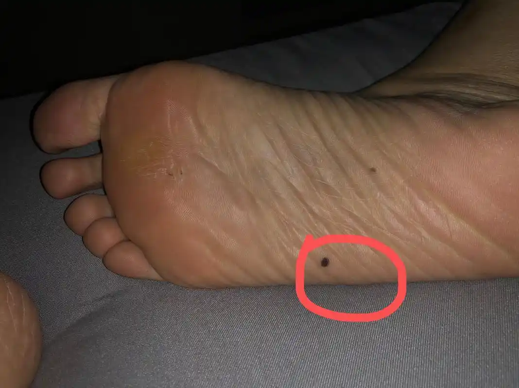 脚底板突然长痣 这颗痣应该是最近两三年长出来,感觉越来越黑,越来越