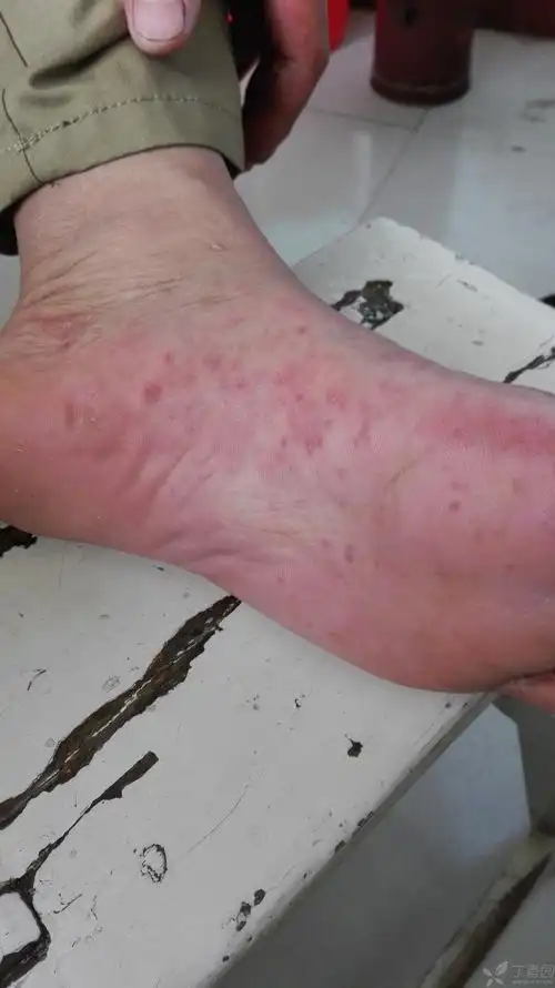 【请教】手脚皮疹是病毒性还是过敏性?