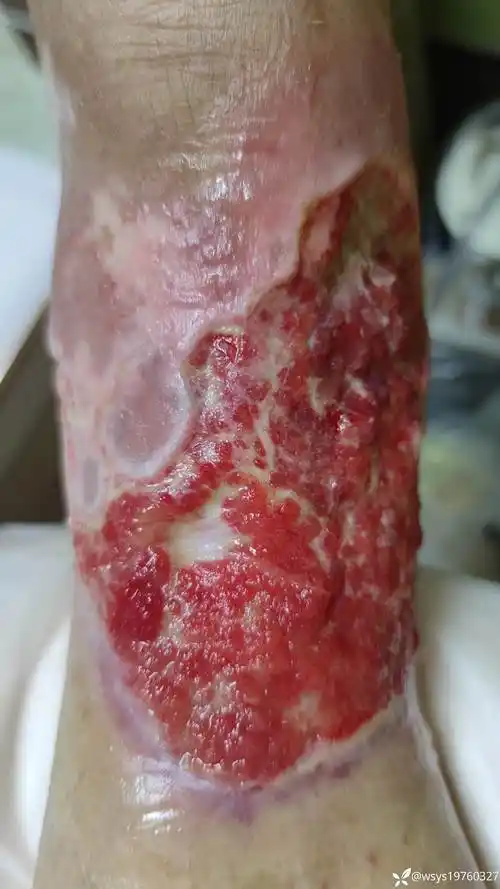 踝关节足靴区及足背皮肤撕脱伤皮肤坏死1月余植皮是打包加压还是选择