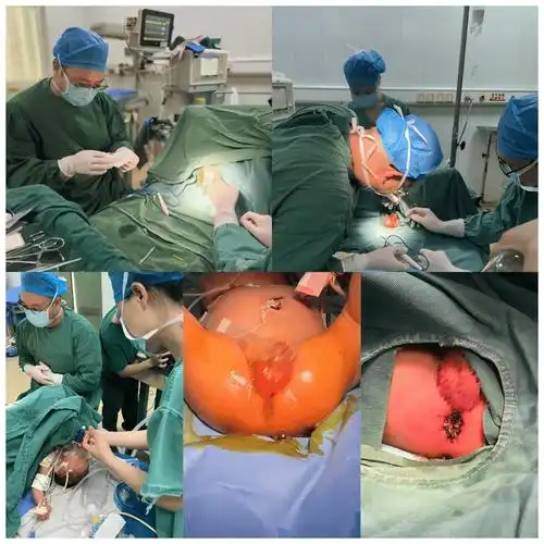 患儿康康于2025年8月19日出生后即被发现肛门完全性闭锁,无法正常排便