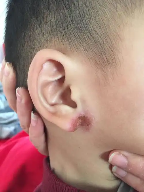 28个月的宝宝耳朵下面老是开裂,看过医生说是湿疹,开了药也不见好