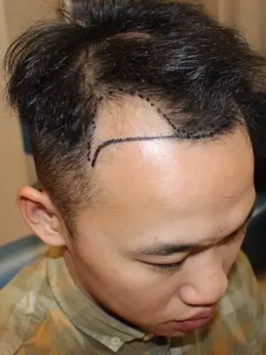 这几年雄秃越来越严重了,两边额角的头发也都掉的差不_圈子-新氧美容