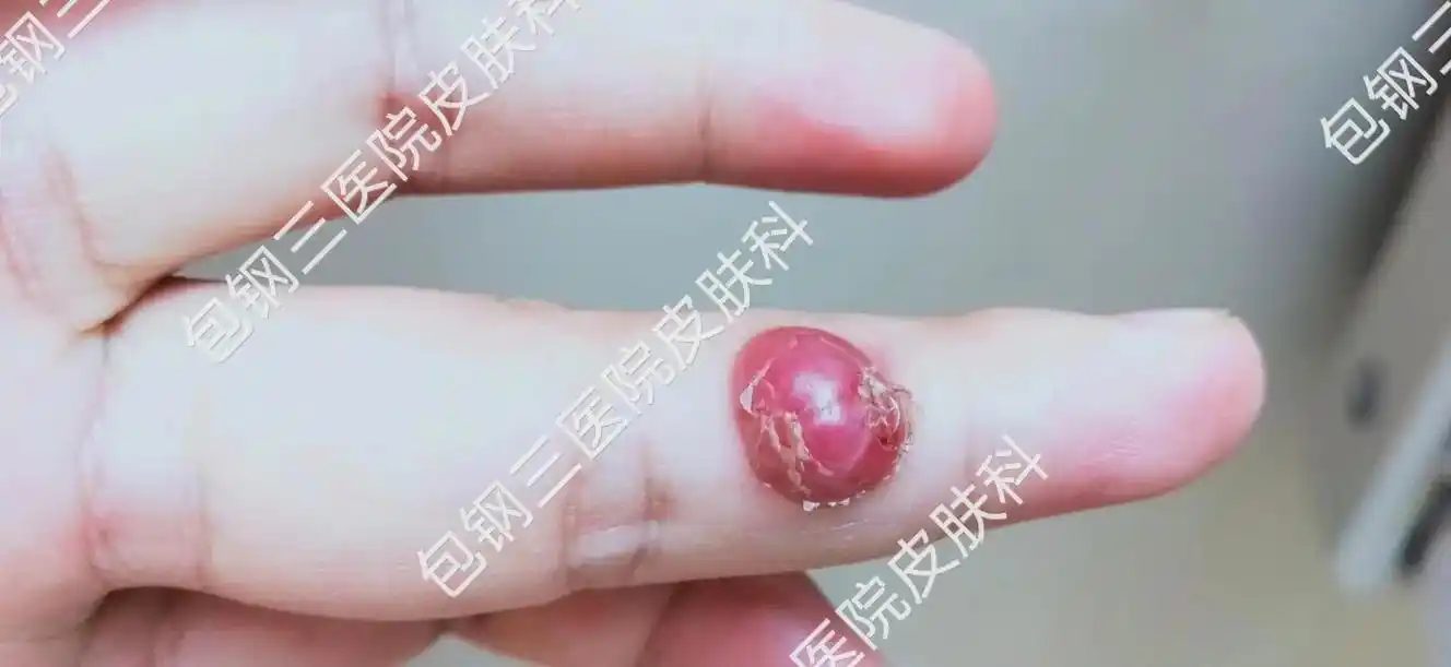 化脓性肉芽肿 #肉芽肿 #手部手术 #包钢三医院 #皮肤 - 抖音