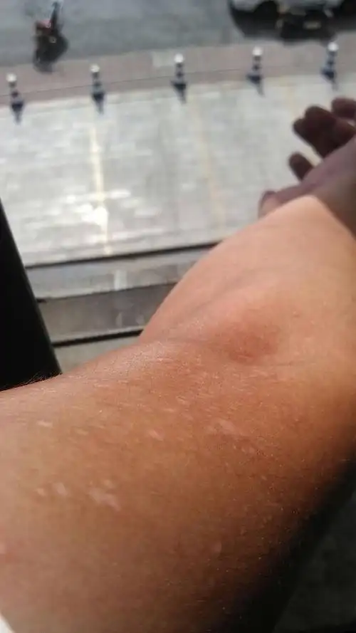 白癜风早期症状图片手臂(手臂皮肤癌早期症状图片)